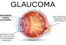 Photo of Enna: giornata di prevenzione del glaucoma con screening e informazione